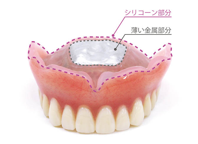 薄い金属によって違和感を緩和