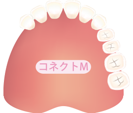 歯が4本連続して抜けた