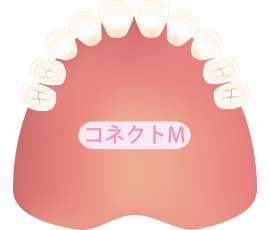 歯が2本両側で抜けた