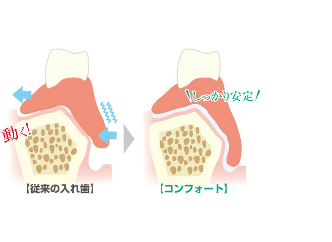 お口のなかでがっちり固定、安定して外れにくい