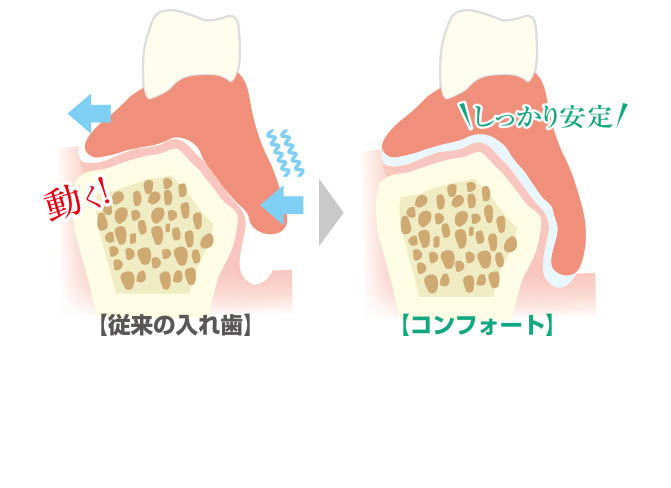 お口のなかでがっちり固定、安定して外れにくい