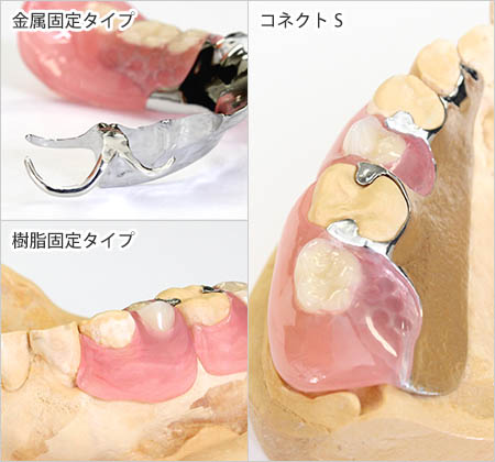 3本〜歯を失った方へ幅広いご利用が可能