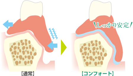 新しい義歯(入れ歯)の選択、コンフォートとは？