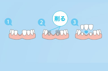 ブリッジのように健康な歯を削らない