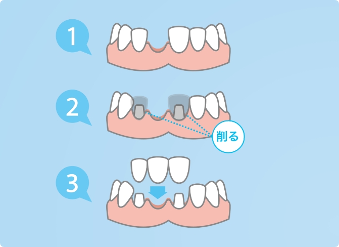 ブリッジのように健康な歯を削らない