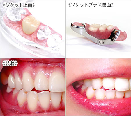 最短たった2 回のご通院で完成する手軽さ