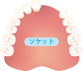 歯が2本抜けた