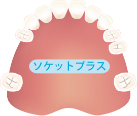 歯が1〜3本抜けた方へ。最短2回の通院でOK 歯を削らずに手術不要