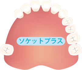 連続して3本抜けた
