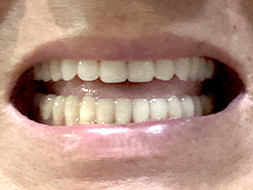 コンフォート加工ご利用者様（70代・男性）装着後