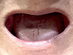 コンフォート加工ご利用者様（70代・男性）装着前